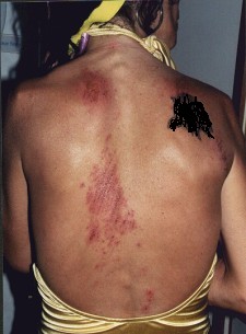 Cuts on Back