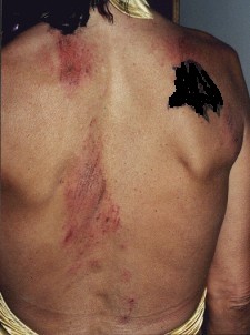 Cuts on Back